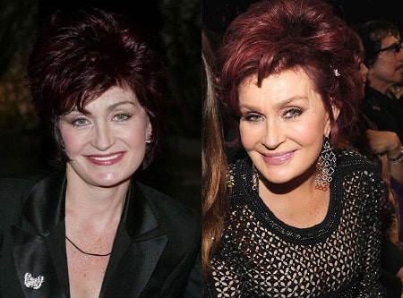 A picture of Sharon Osbourne before (left) and after (right).